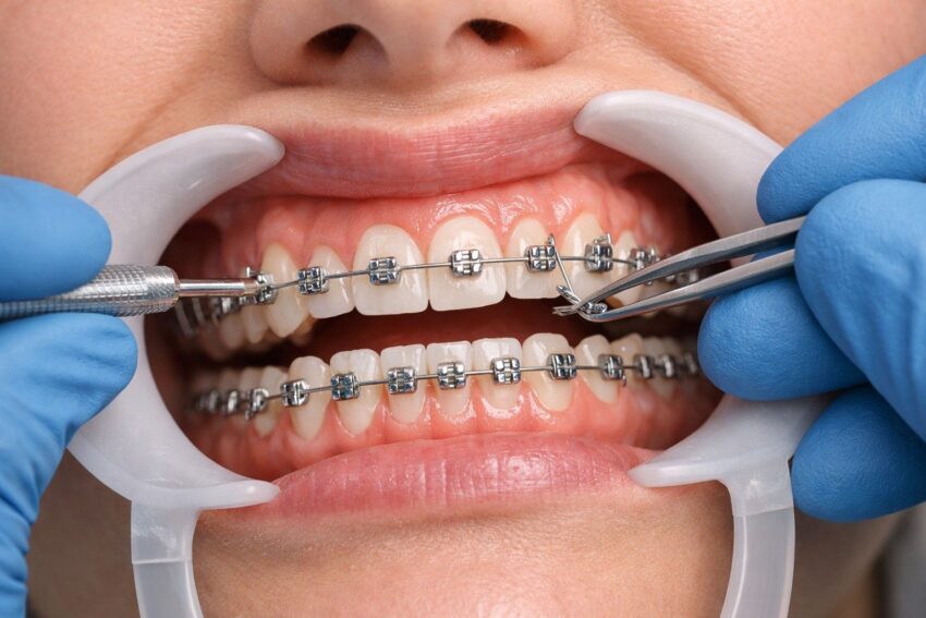 How Braces Influence Sleep Quality and Breathing Patterns